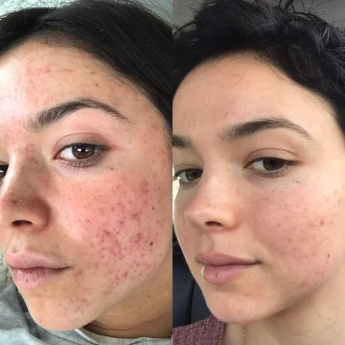 Máscara de Luz LED Facial